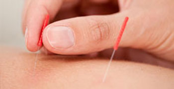 Acupuncture